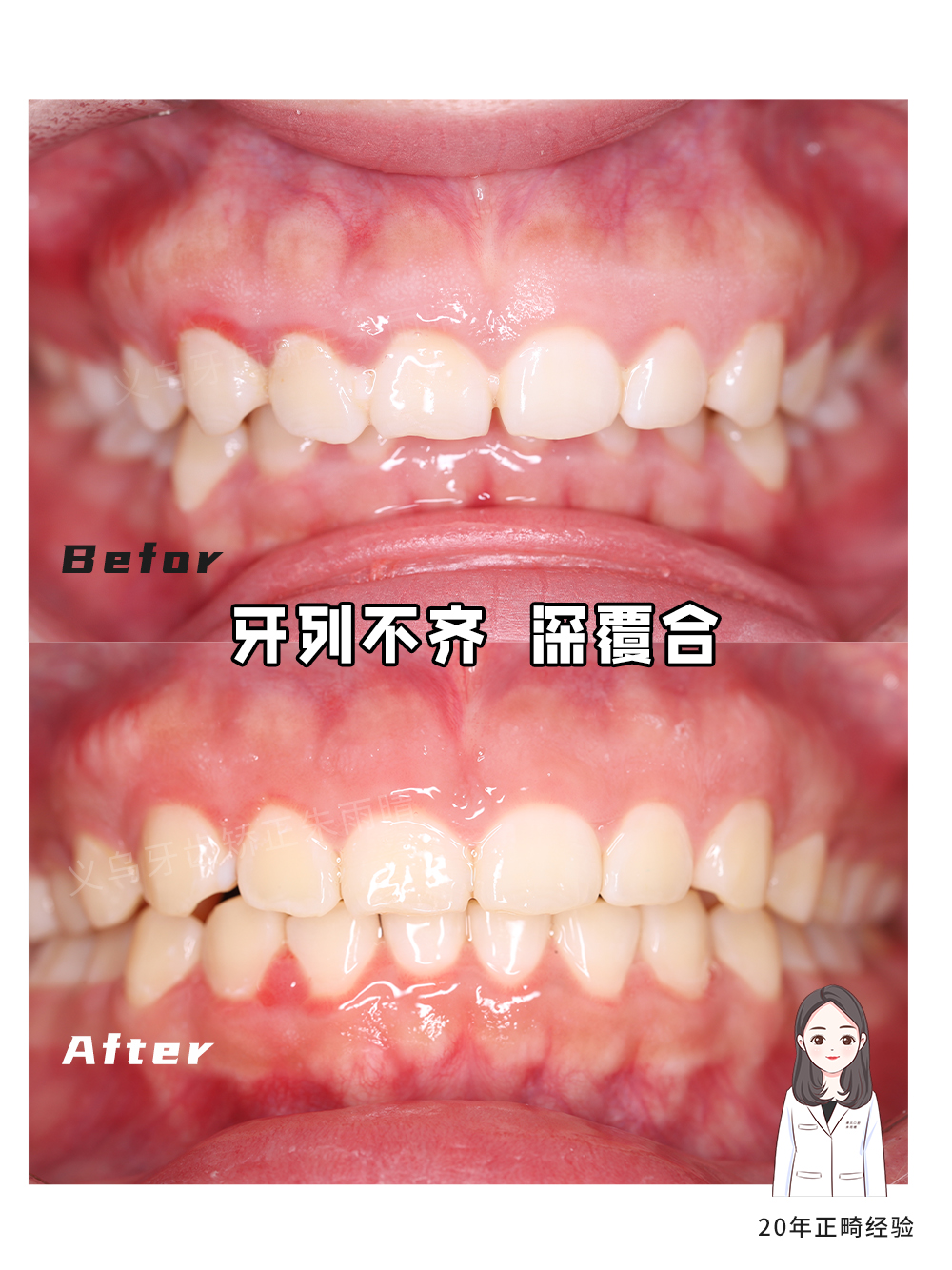 义乌傅氏口腔牙列不齐深覆合矫正案例分享！