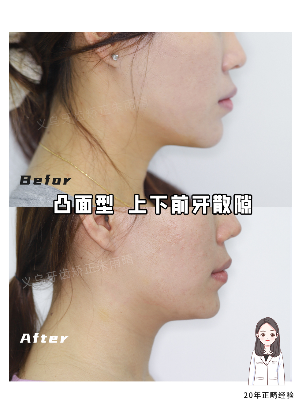 义乌傅氏口腔凸面型上下前牙散隙矫正案例分享！