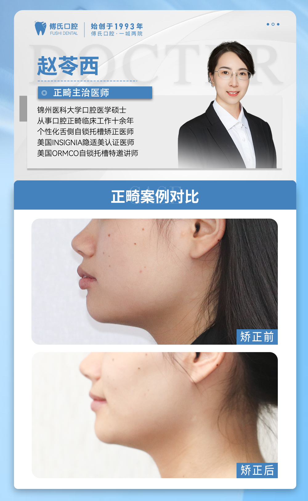 义乌傅氏口腔牙齿前突、嘴凸矫正案例分享! 义乌傅氏口腔牙齿前突、嘴凸矫正案例分享!