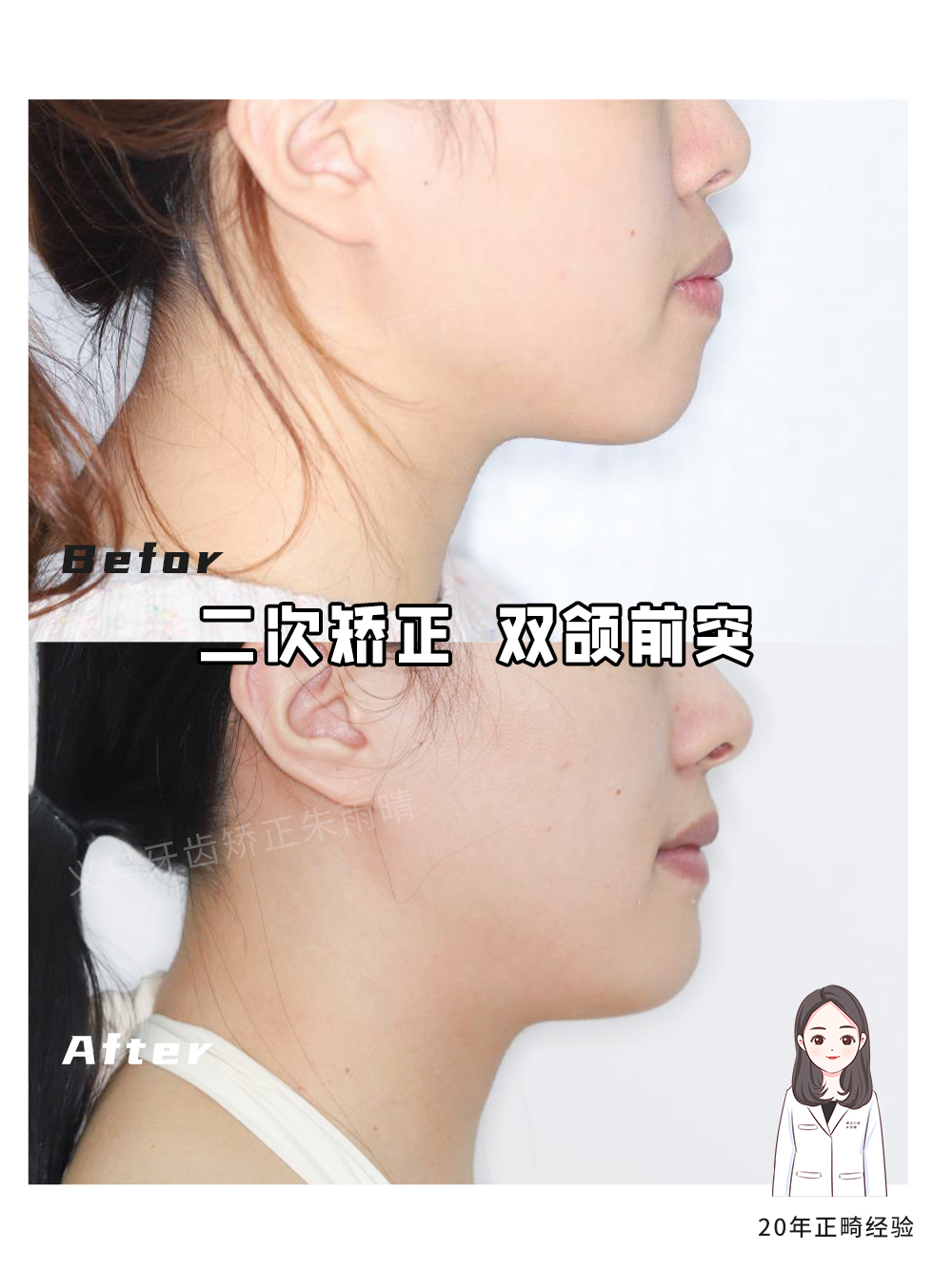 义乌傅氏口腔嘴凸二次矫正案例分享！