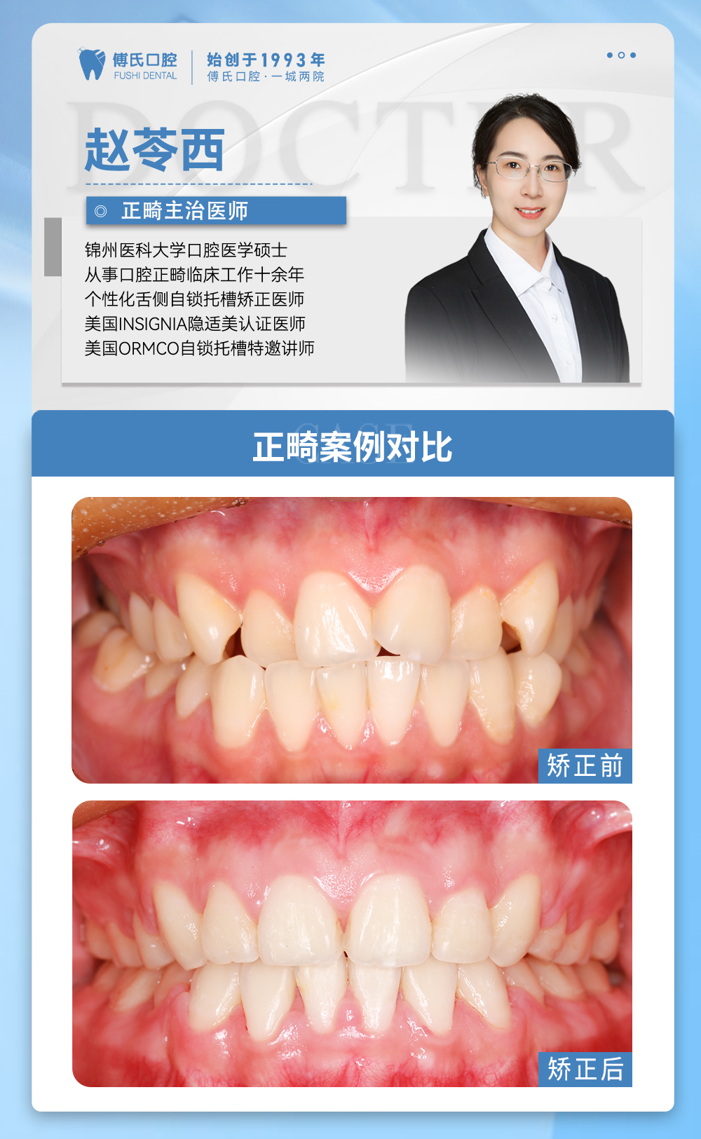 傅氏口腔牙齿拥挤侧貌微凸矫正案例分享! 傅氏口腔牙齿拥挤侧貌微凸矫正案例分享!
