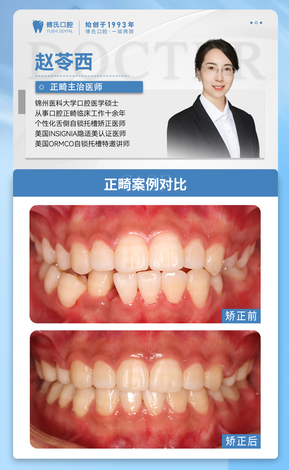 义乌傅氏口腔下颌后缩矫正案例分享！
