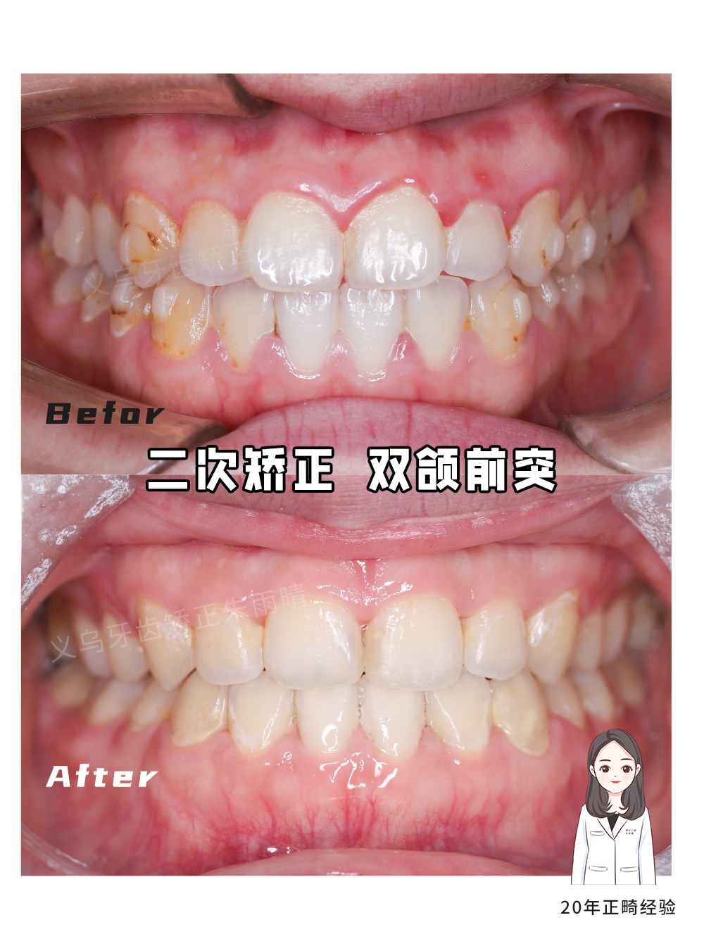 义乌傅氏口腔嘴凸二次矫正案例分享！