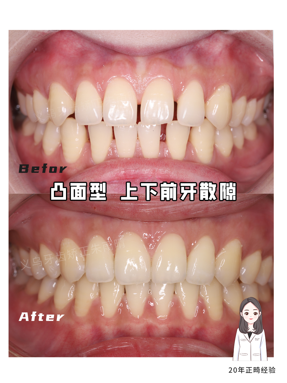 义乌傅氏口腔凸面型上下前牙散隙矫正案例分享！