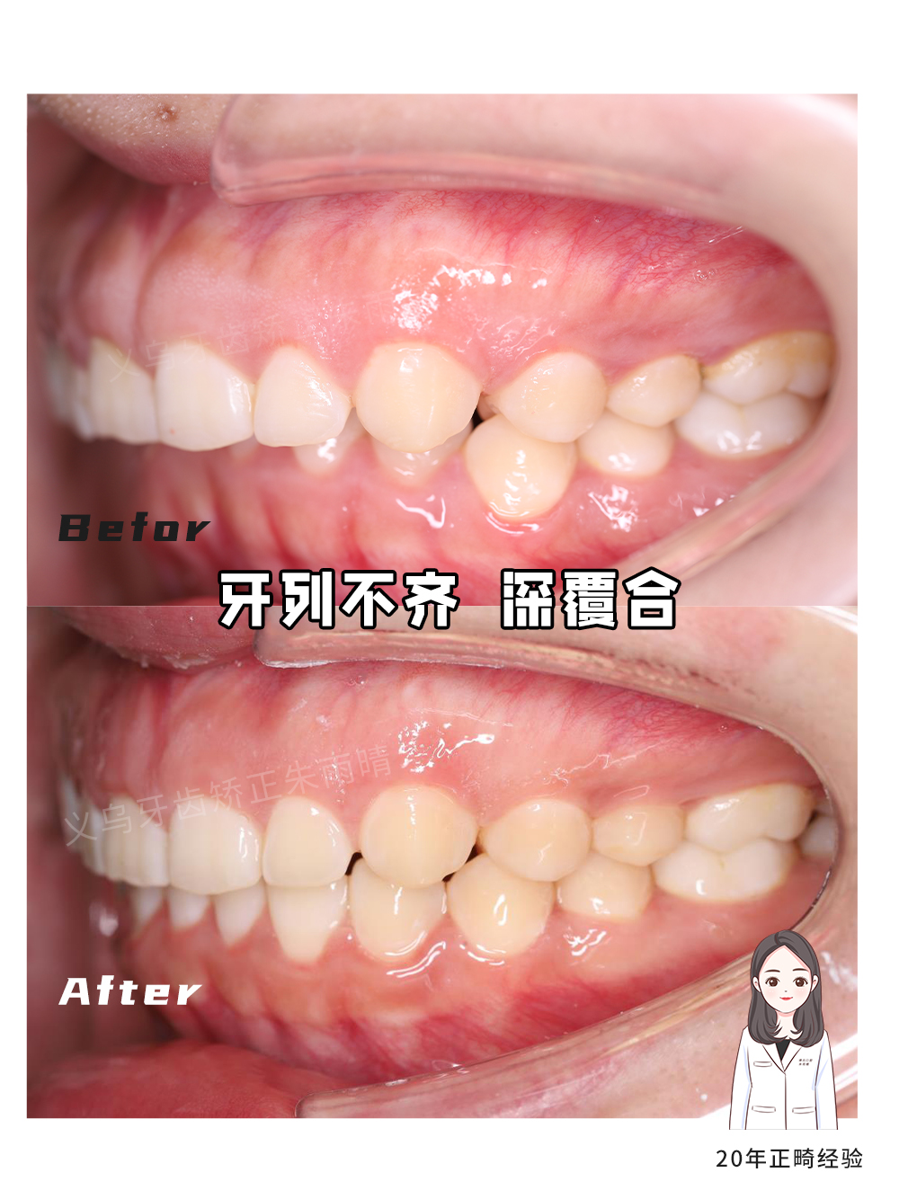 义乌傅氏口腔牙列不齐深覆合矫正案例分享！