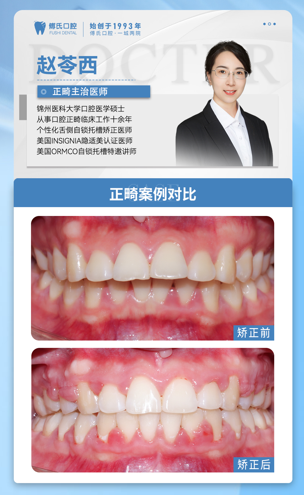 义乌傅氏口腔牙齿前突、嘴凸矫正案例分享! 义乌傅氏口腔牙齿前突、嘴凸矫正案例分享!