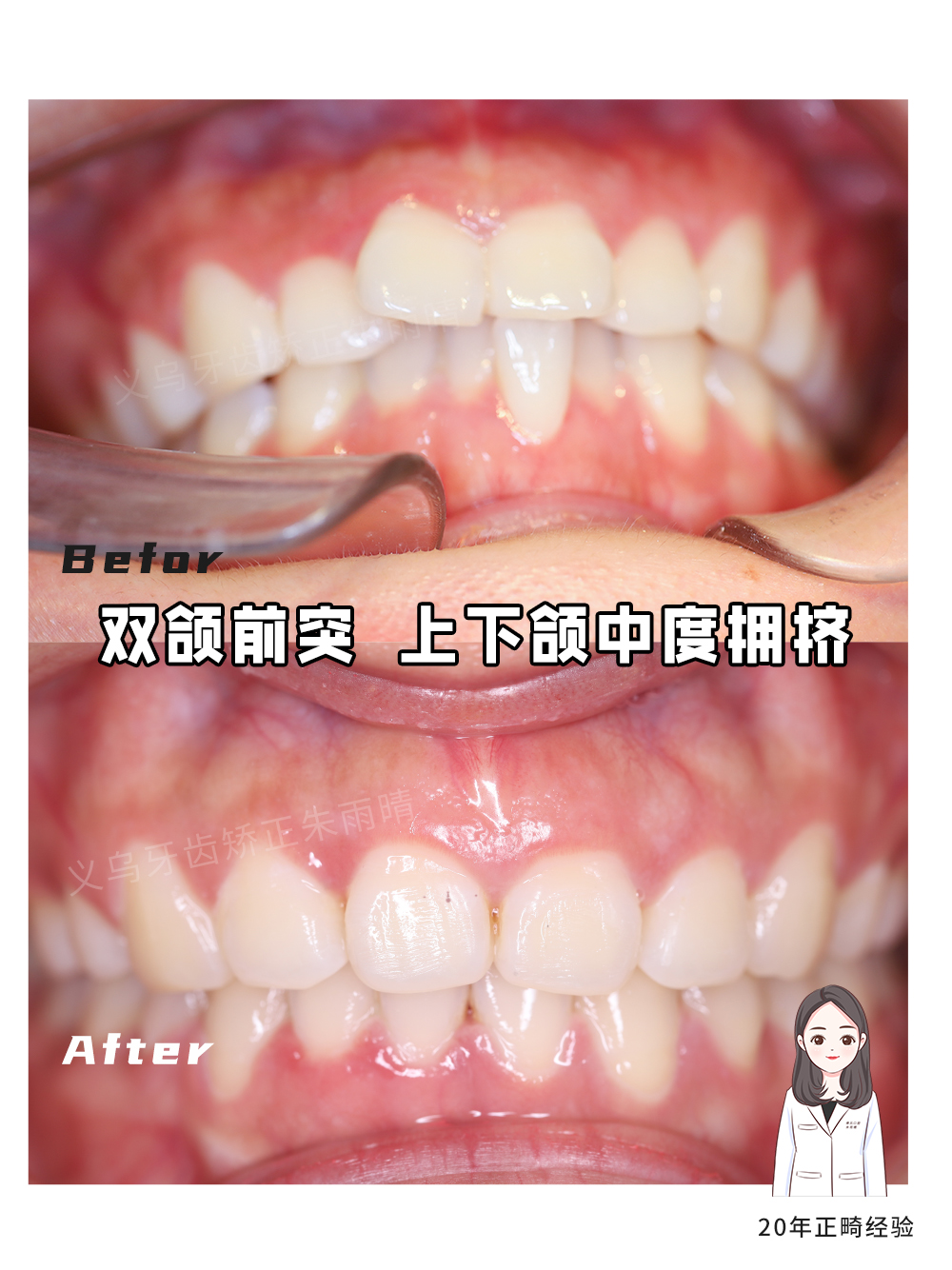义乌傅氏口腔嘴凸上下颌中度拥挤矫正案例分享！