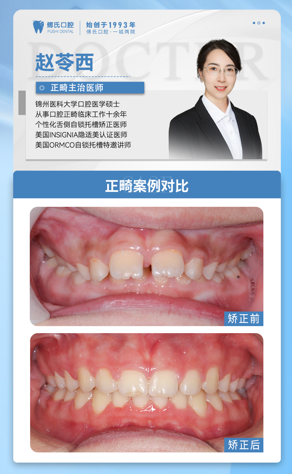 义乌傅氏口腔嘴凸下巴后缩牙齿散隙矫正案例分享！