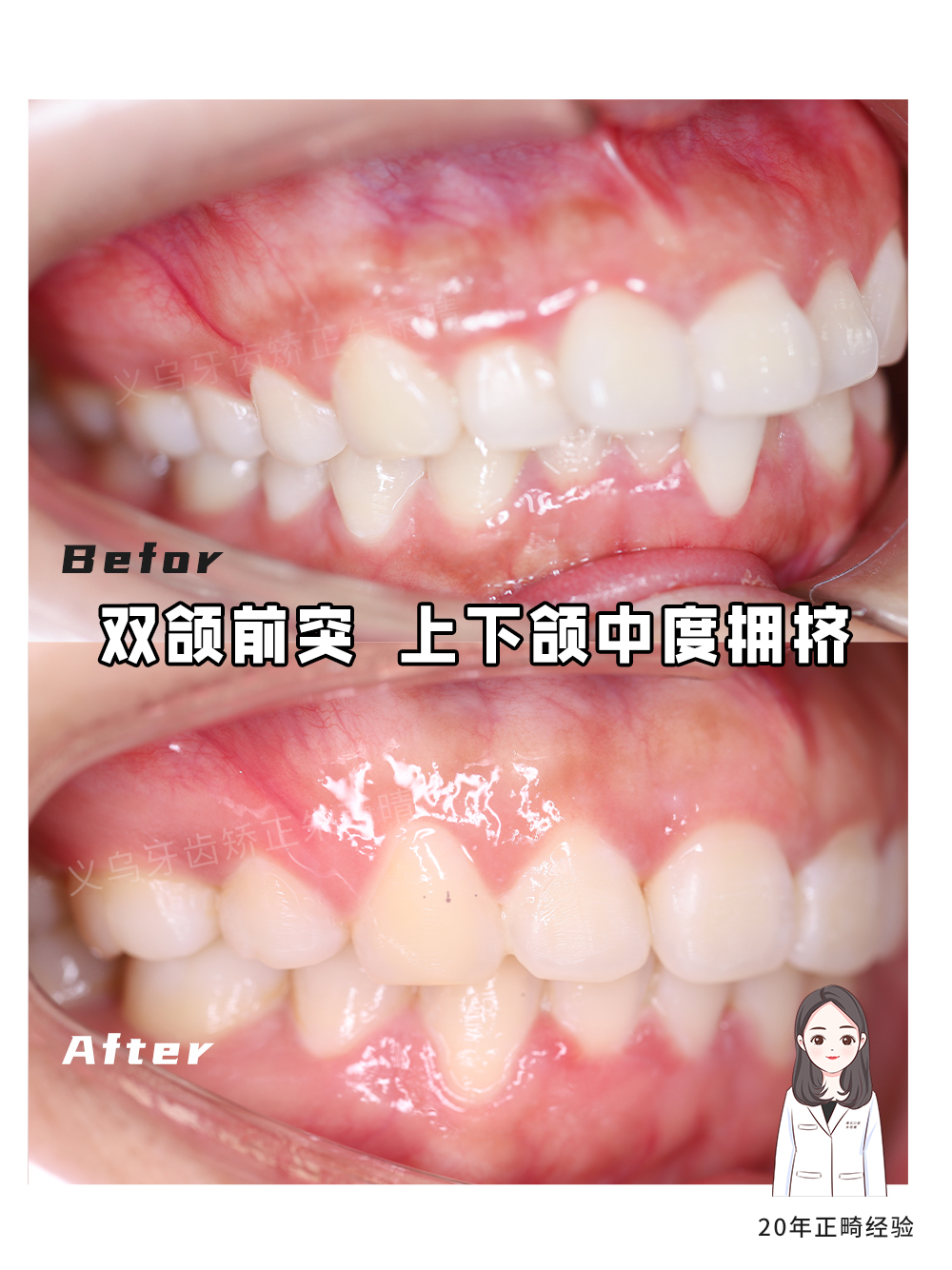 义乌傅氏口腔嘴凸上下颌中度拥挤矫正案例分享！