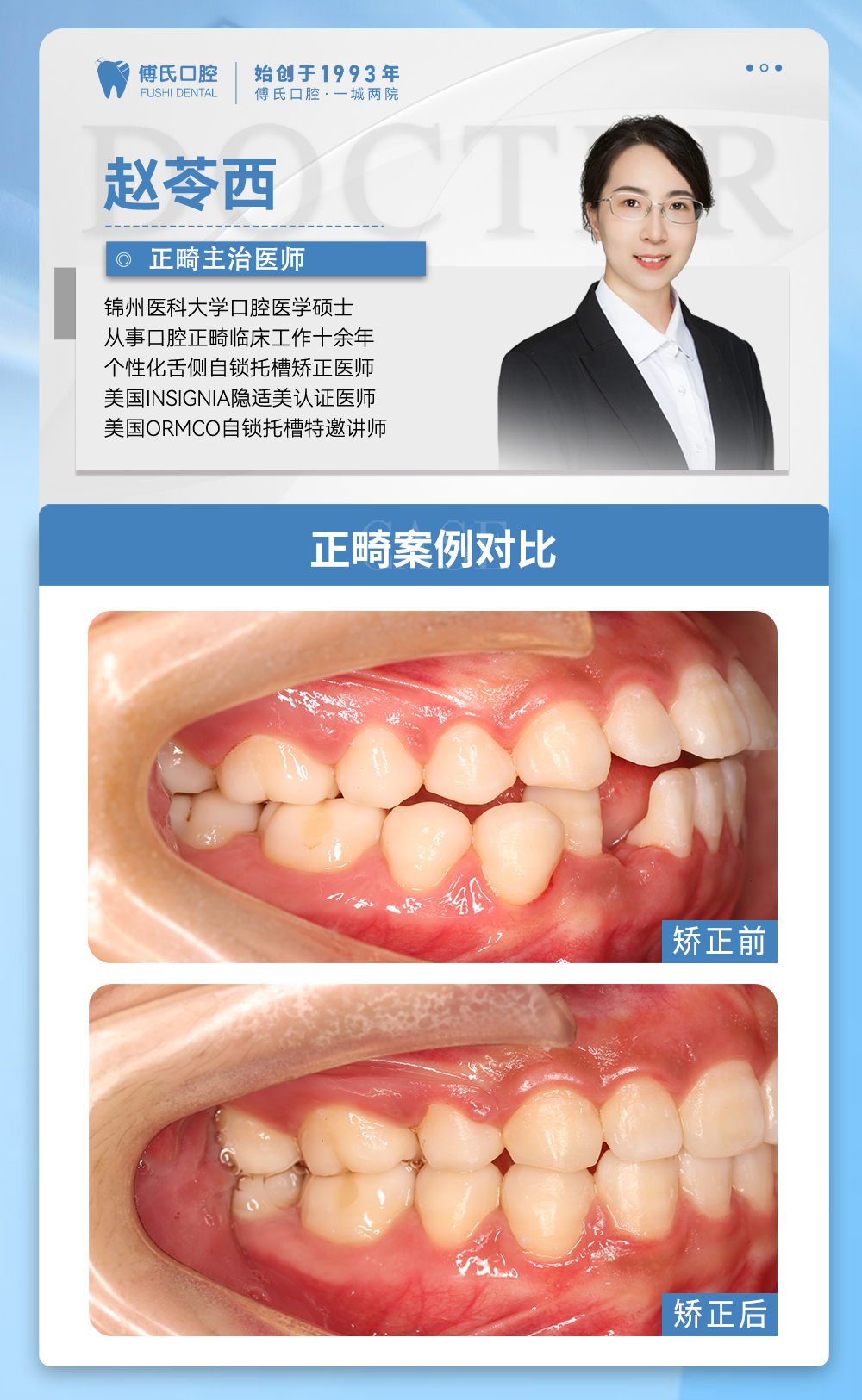 义乌傅氏口腔下颌后缩矫正案例分享！