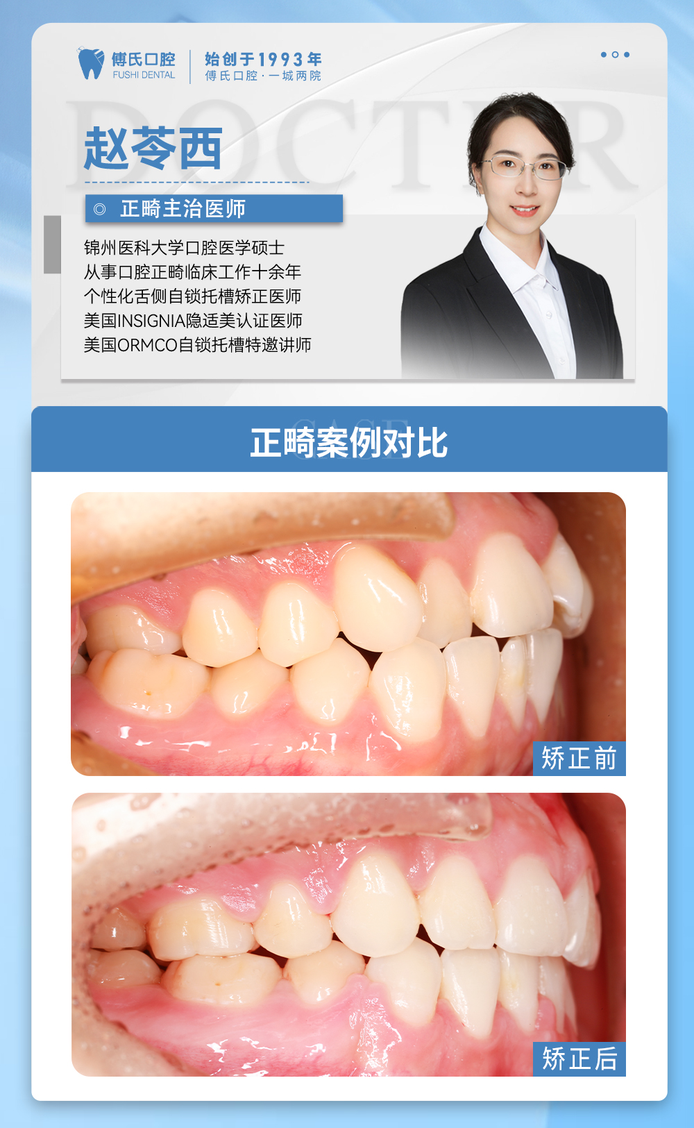 傅氏口腔牙齿拥挤侧貌微凸矫正案例分享! 傅氏口腔牙齿拥挤侧貌微凸矫正案例分享!