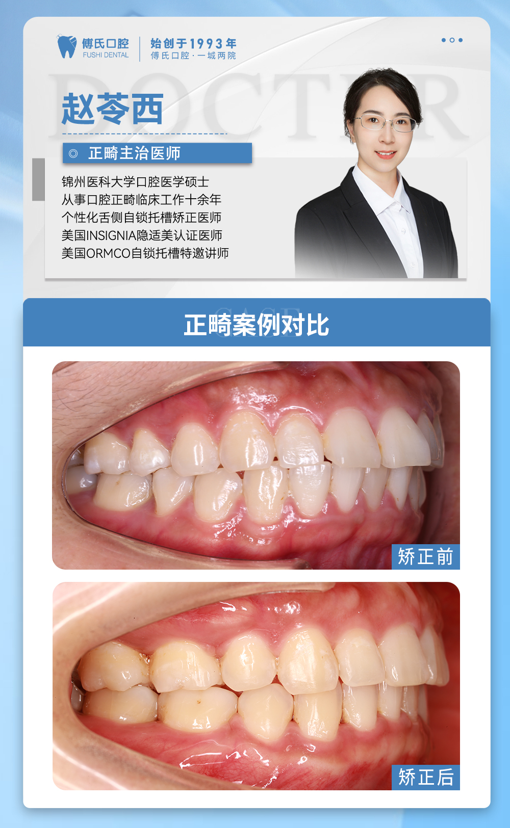 义乌傅氏口腔嘴凸下巴后缩矫正案例分享！