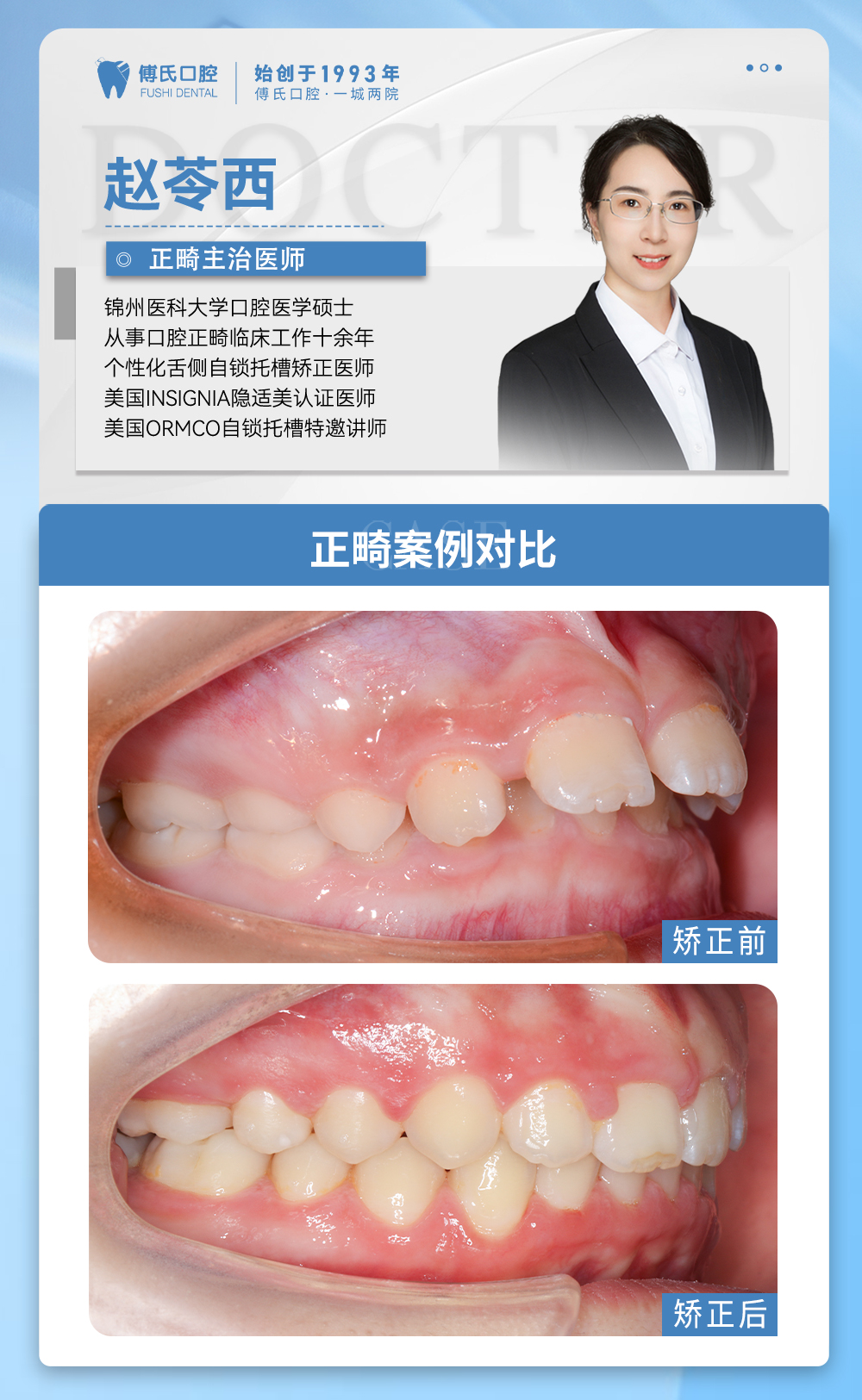 义乌傅氏口腔嘴凸下巴后缩牙齿散隙矫正案例分享！
