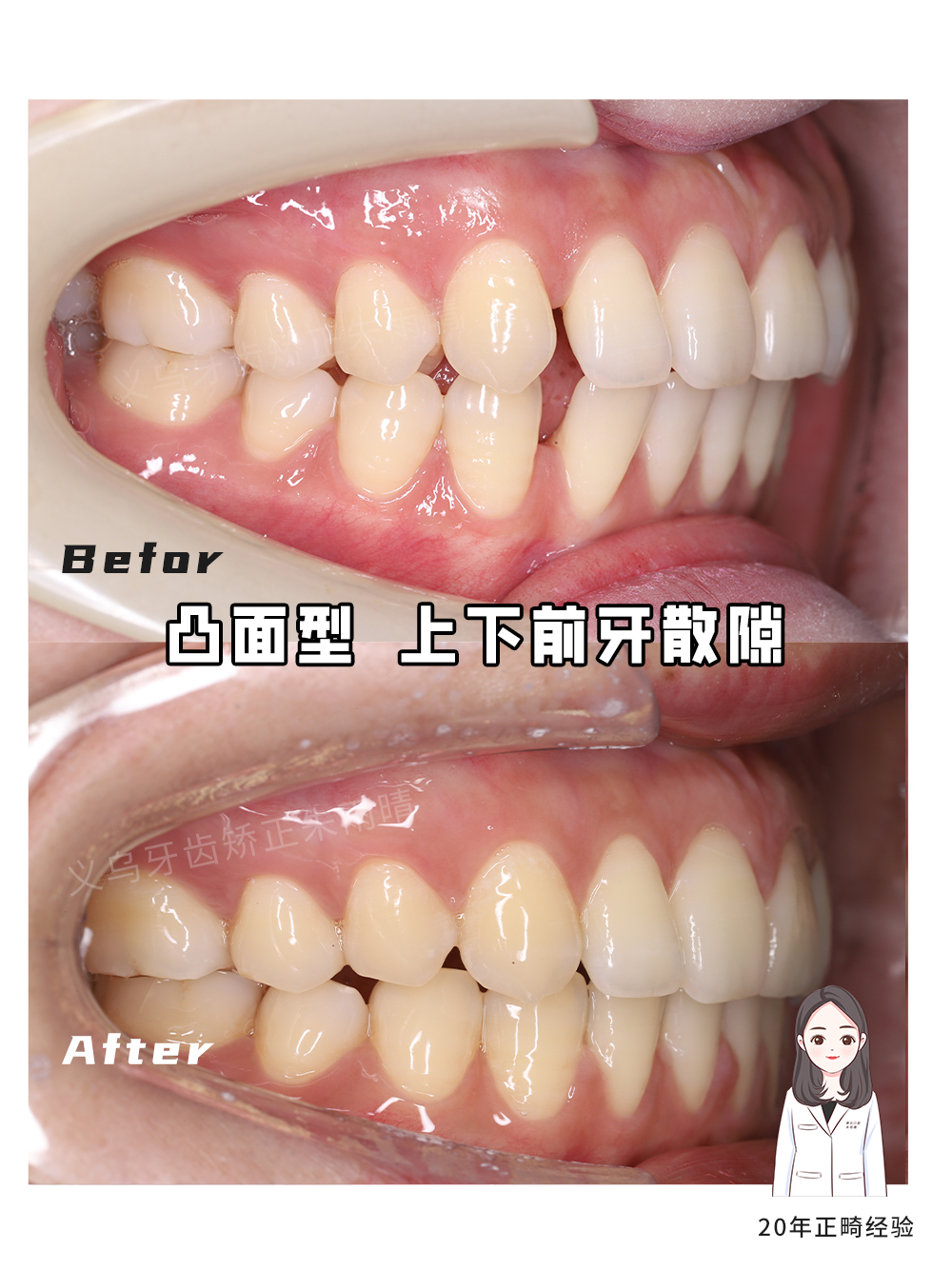 义乌傅氏口腔凸面型上下前牙散隙矫正案例分享！