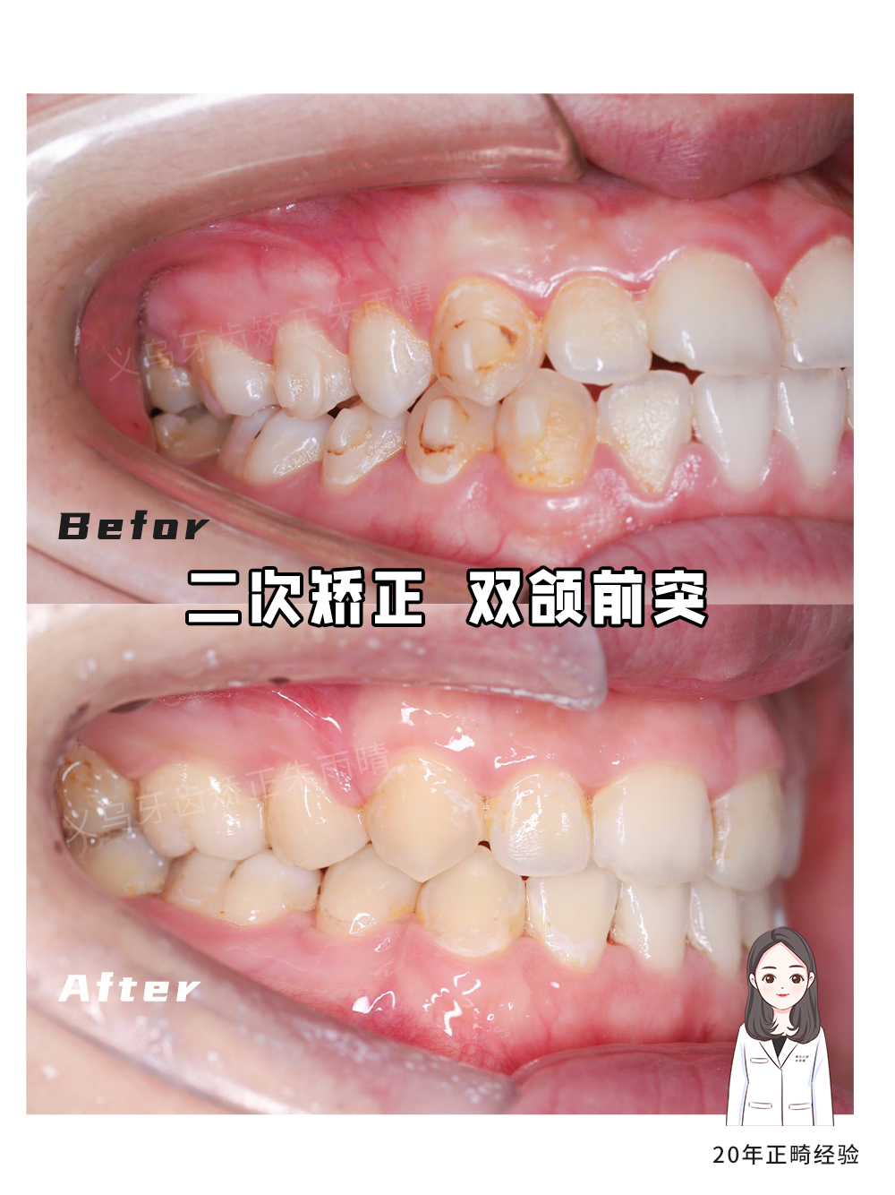 义乌傅氏口腔嘴凸二次矫正案例分享！
