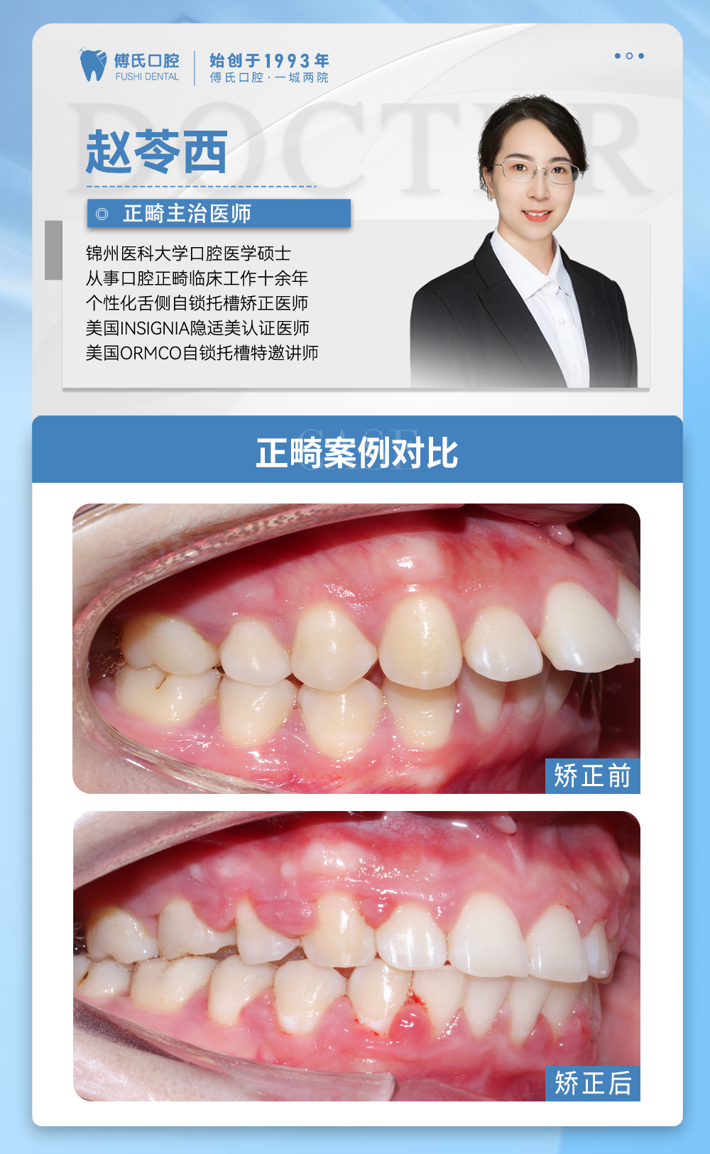 义乌傅氏口腔牙齿前突、嘴凸矫正案例分享! 义乌傅氏口腔牙齿前突、嘴凸矫正案例分享!