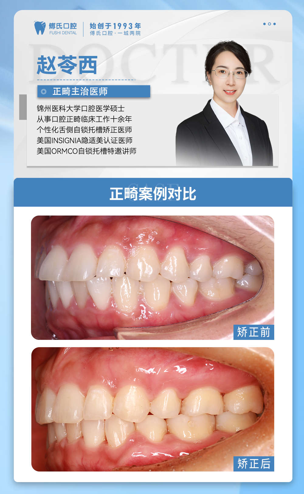 义乌傅氏口腔嘴凸下巴后缩矫正案例分享！