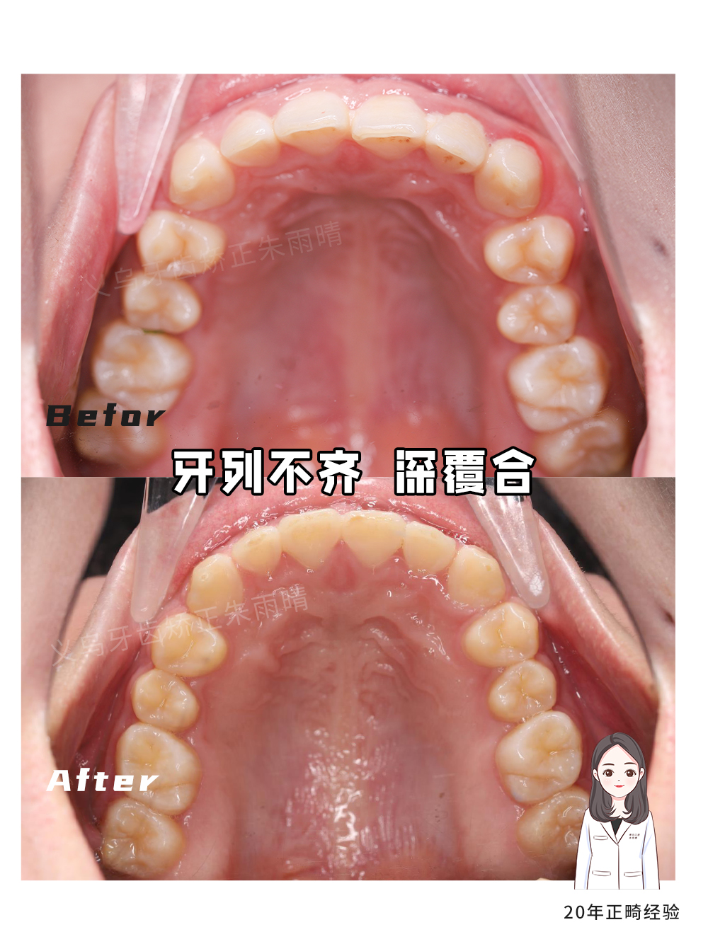 义乌傅氏口腔牙列不齐深覆合矫正案例分享！