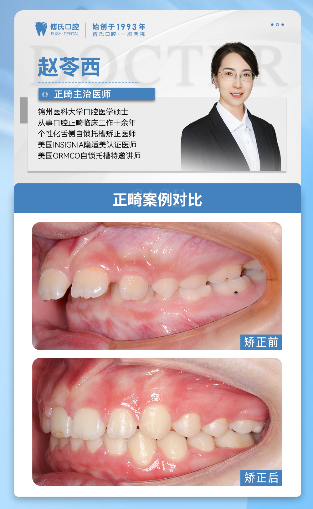 义乌傅氏口腔嘴凸下巴后缩牙齿散隙矫正案例分享！
