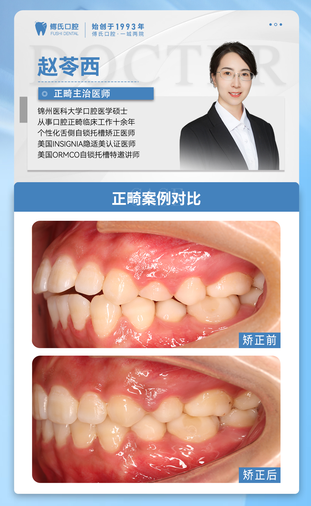义乌傅氏口腔下颌后缩矫正案例分享！