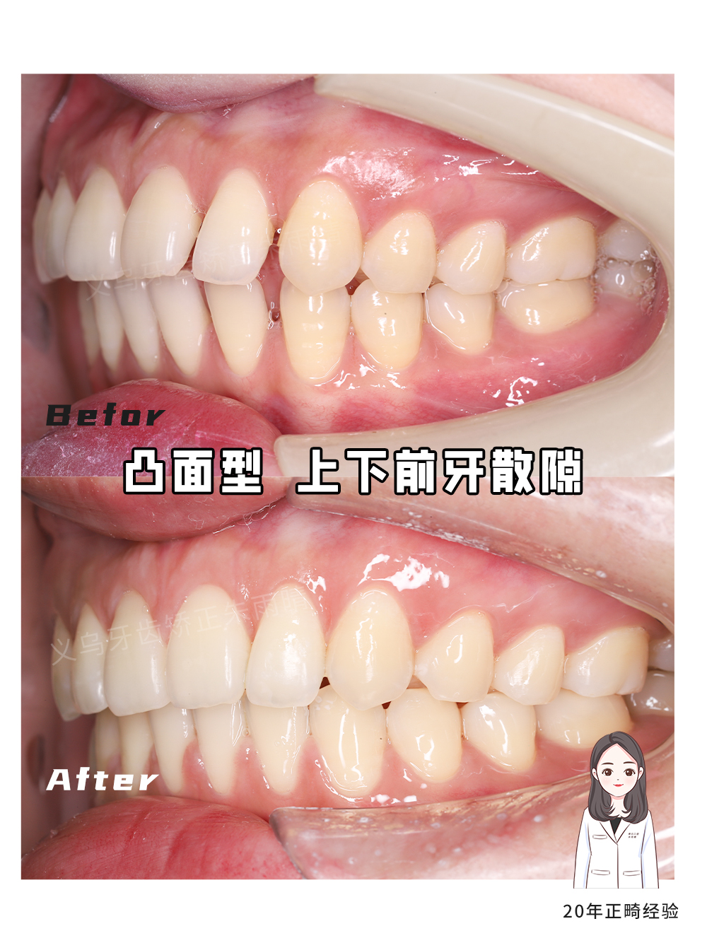 义乌傅氏口腔凸面型上下前牙散隙矫正案例分享！