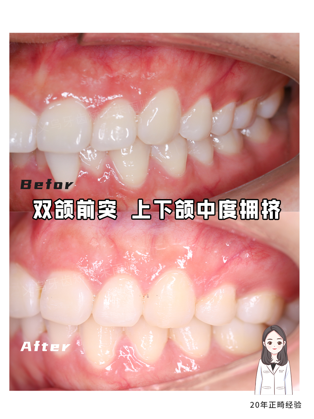 义乌傅氏口腔嘴凸上下颌中度拥挤矫正案例分享！