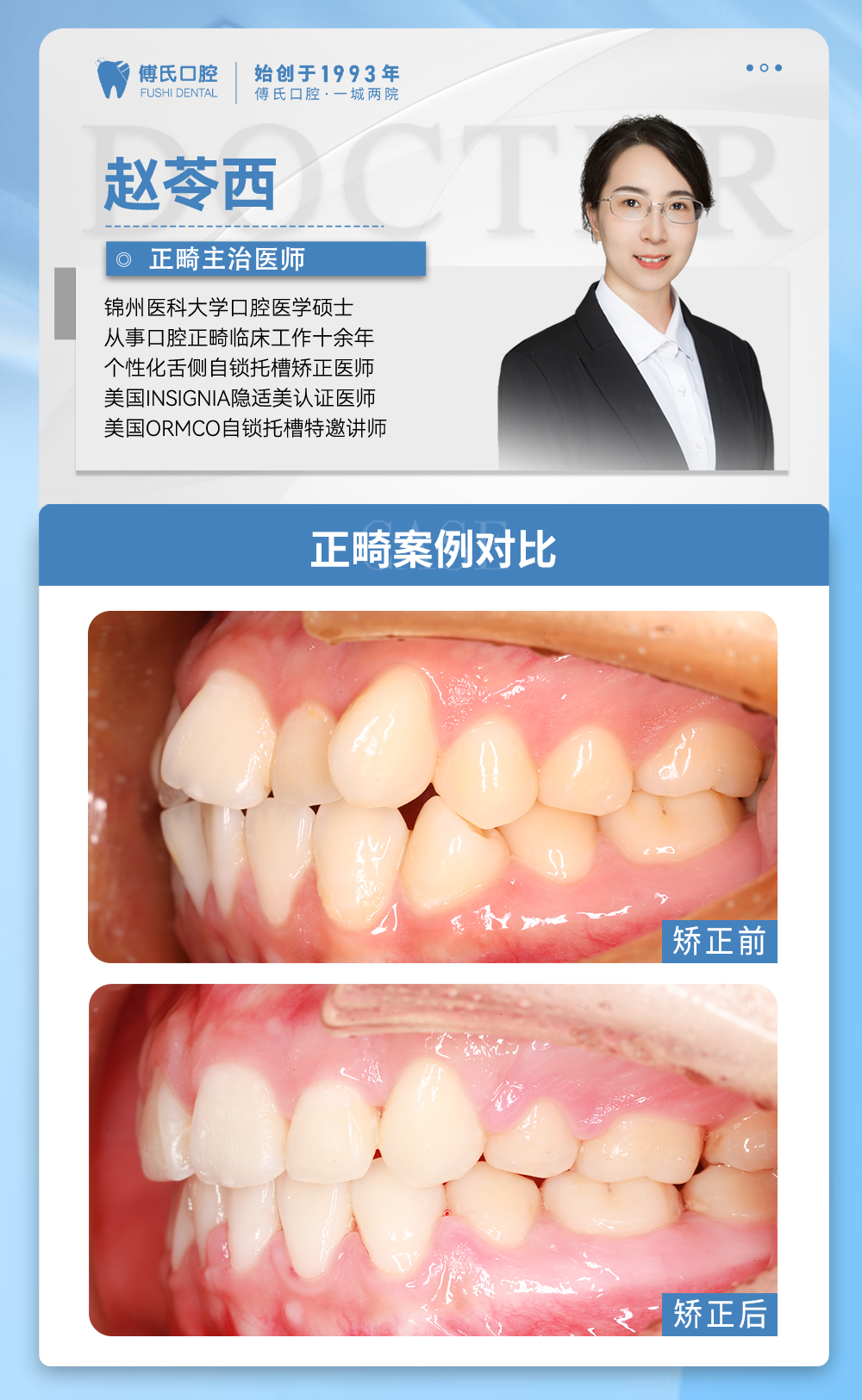 傅氏口腔牙齿拥挤侧貌微凸矫正案例分享! 傅氏口腔牙齿拥挤侧貌微凸矫正案例分享!
