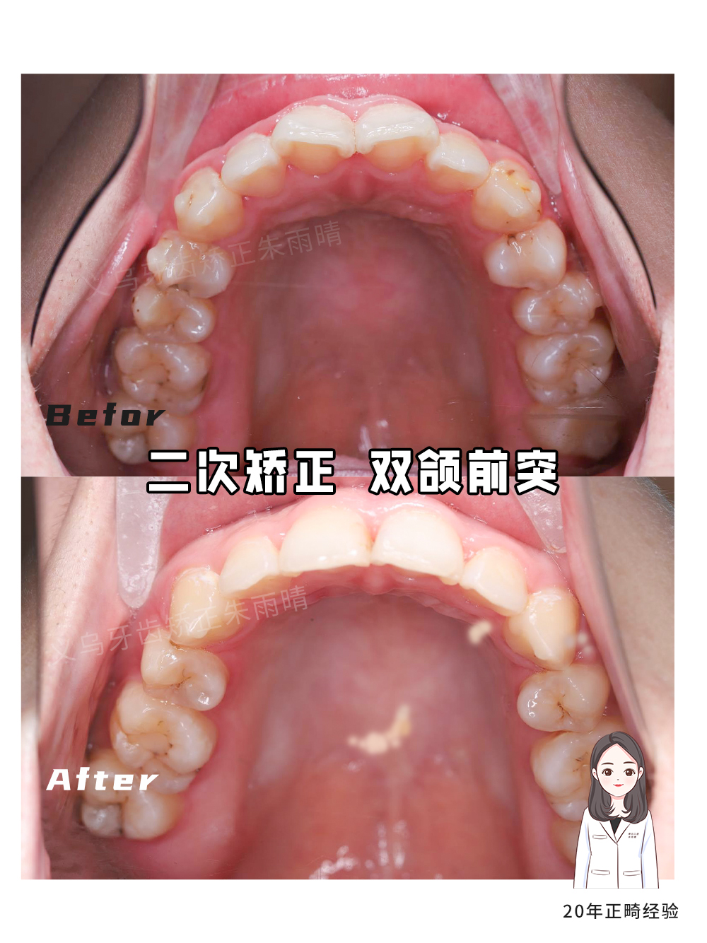 义乌傅氏口腔嘴凸二次矫正案例分享！