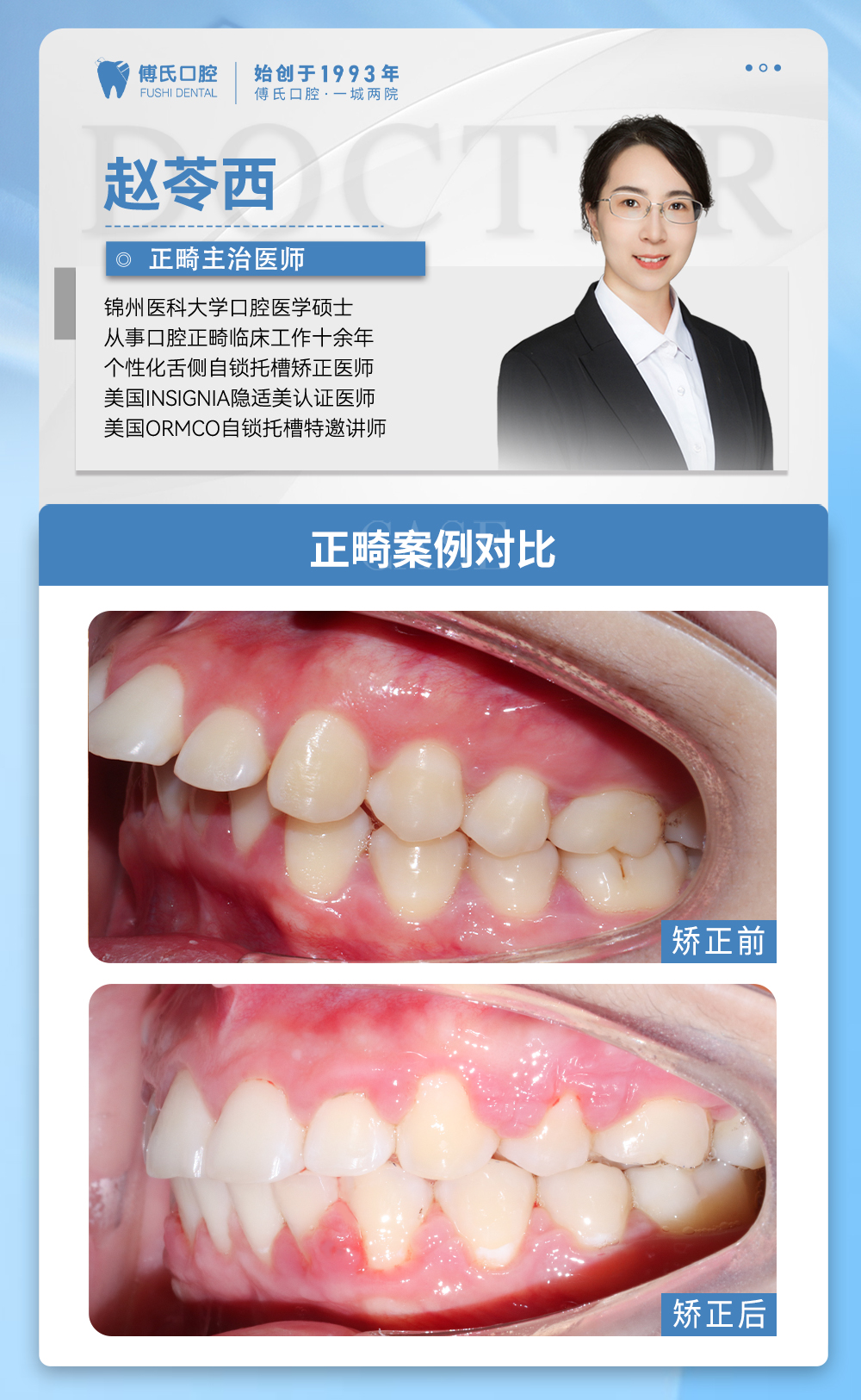 义乌傅氏口腔牙齿前突、嘴凸矫正案例分享! 义乌傅氏口腔牙齿前突、嘴凸矫正案例分享!
