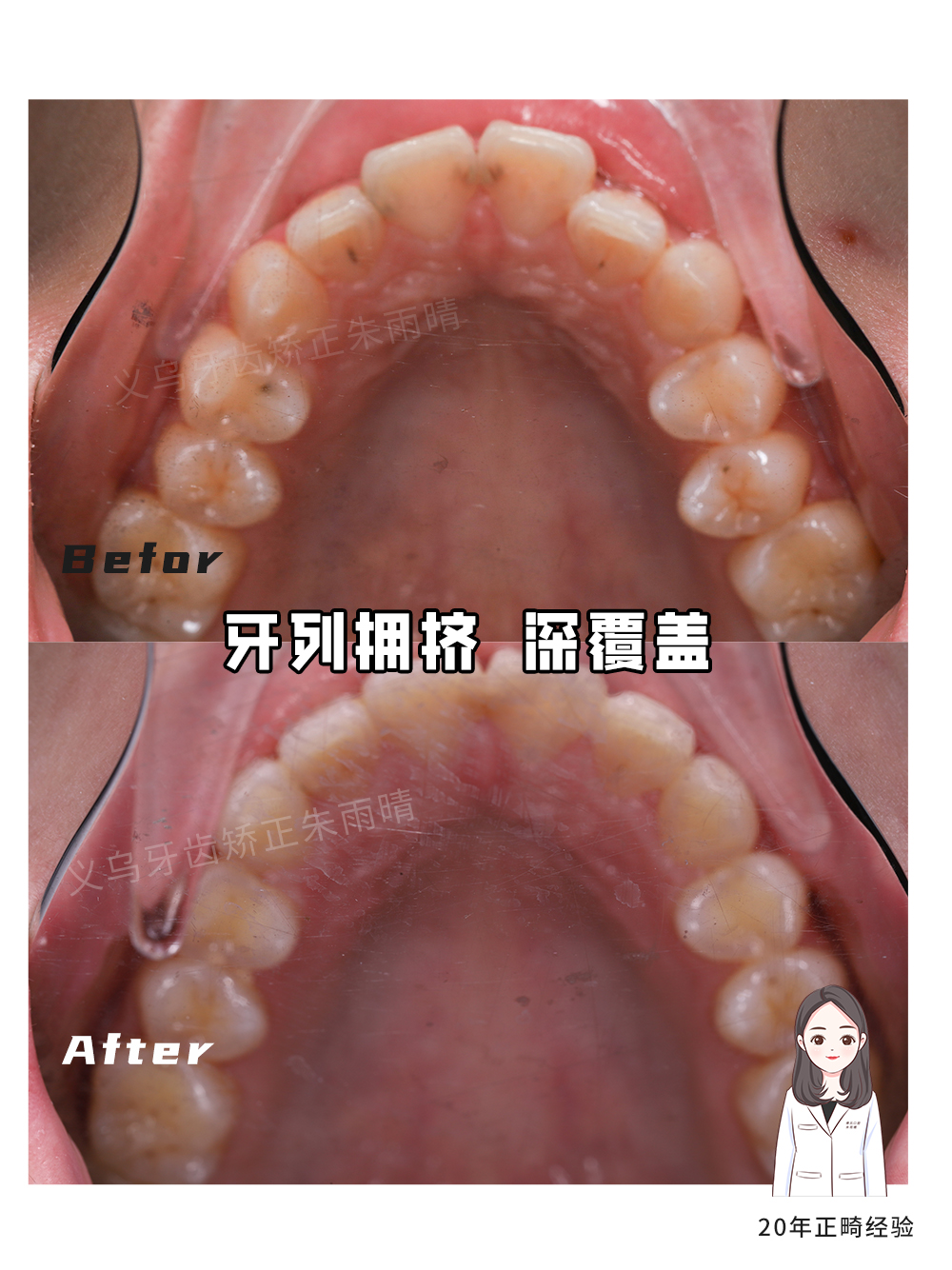 义乌傅氏口腔牙列拥挤深覆盖矫正案例分享！