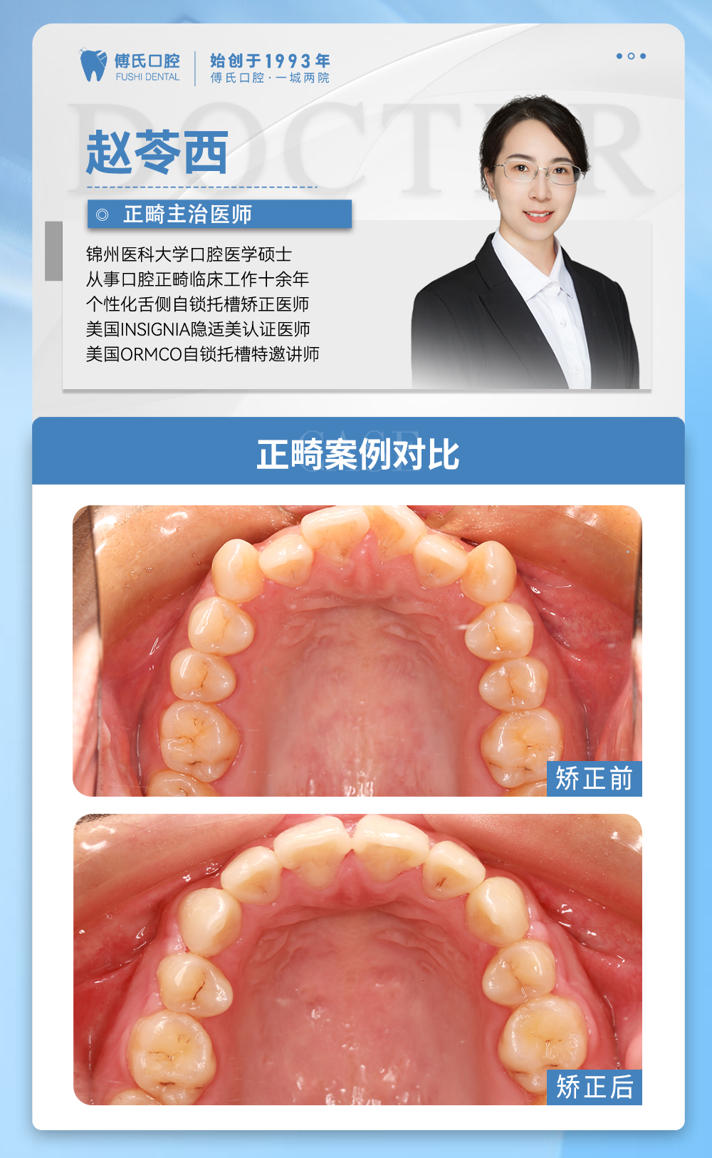 傅氏口腔牙齿拥挤侧貌微凸矫正案例分享! 傅氏口腔牙齿拥挤侧貌微凸矫正案例分享!