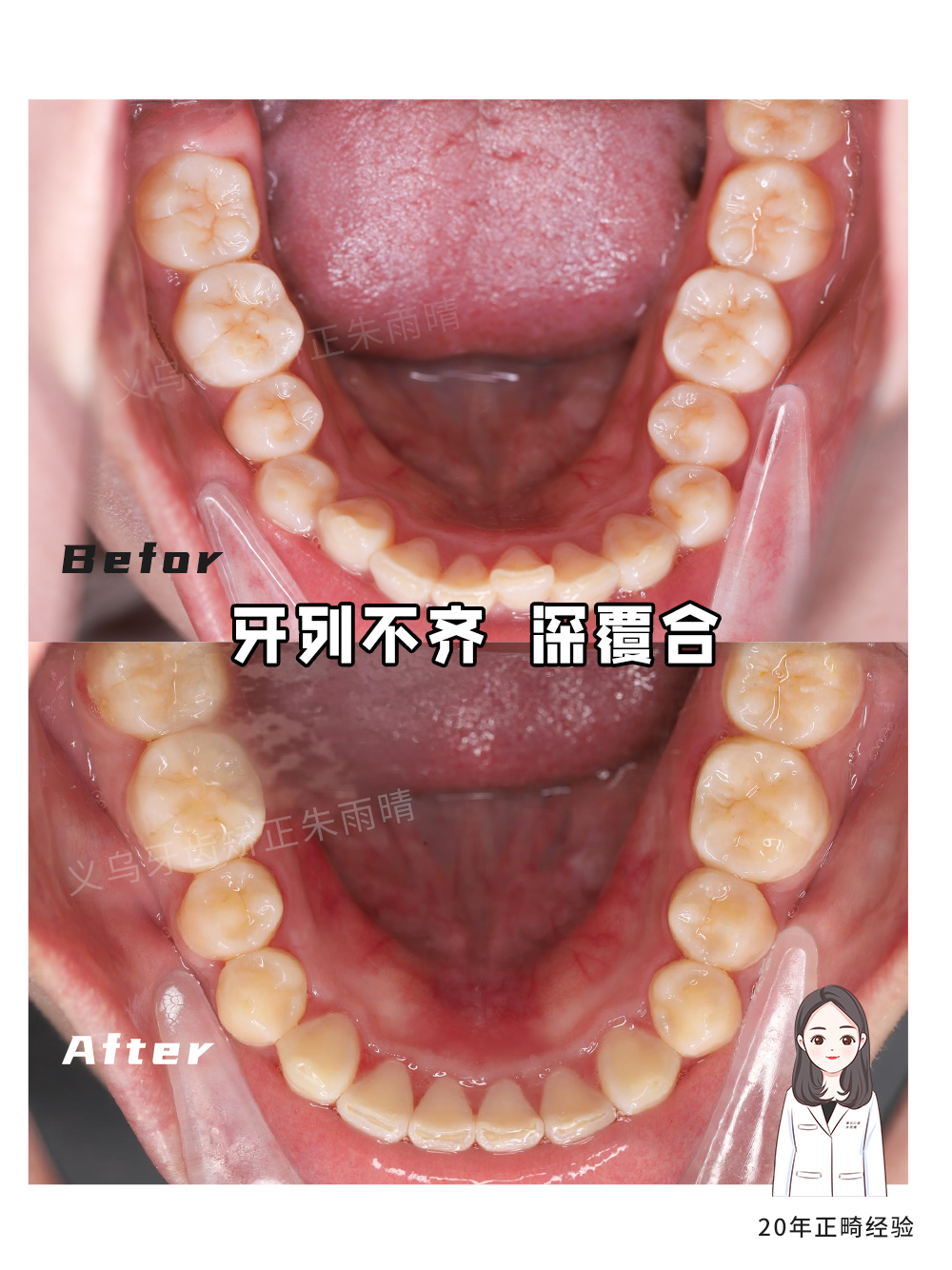 义乌傅氏口腔牙列不齐深覆合矫正案例分享！