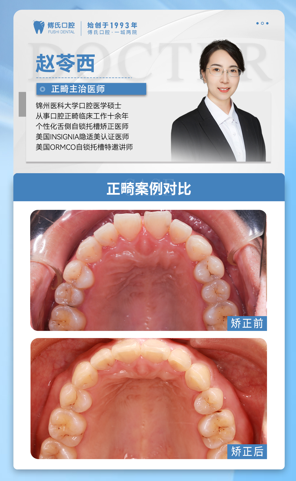 义乌傅氏口腔嘴凸下巴后缩矫正案例分享！