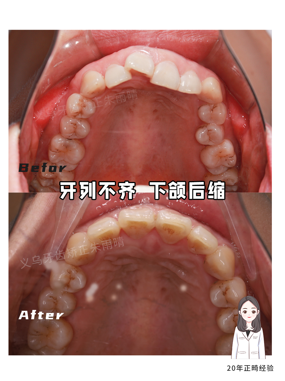 义乌傅氏口腔牙列不齐下颌后缩矫正案例分享！