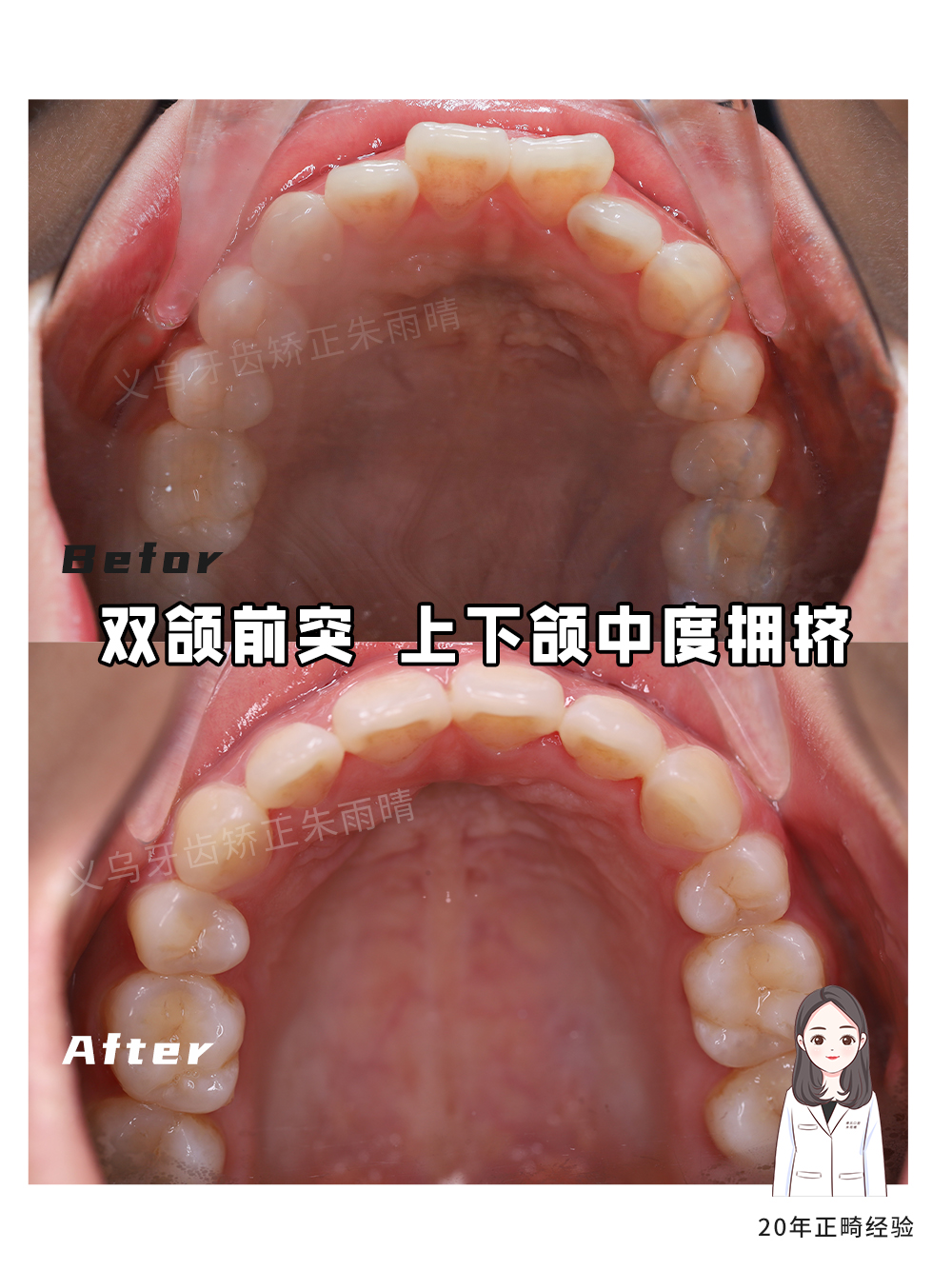 义乌傅氏口腔嘴凸上下颌中度拥挤矫正案例分享！