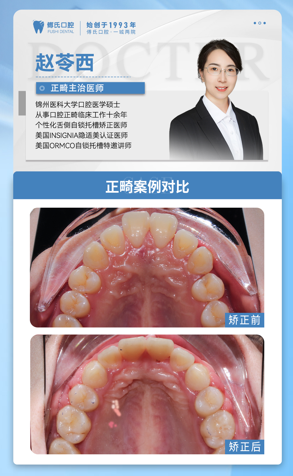 义乌傅氏口腔牙齿前突、嘴凸矫正案例分享! 义乌傅氏口腔牙齿前突、嘴凸矫正案例分享!