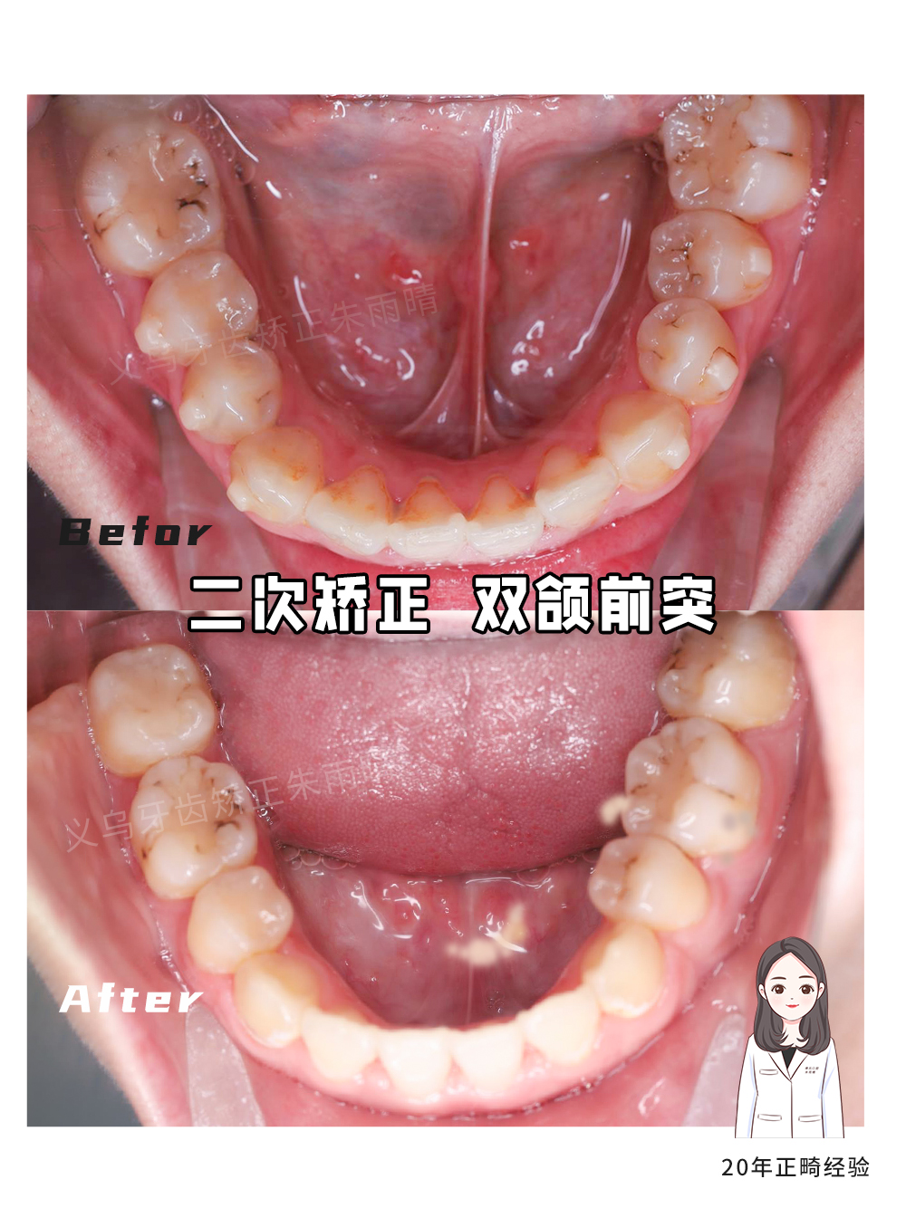 义乌傅氏口腔嘴凸二次矫正案例分享！