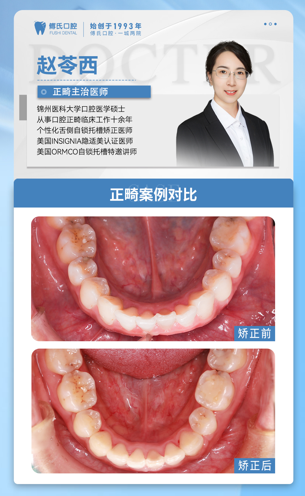 义乌傅氏口腔嘴凸下巴后缩矫正案例分享！