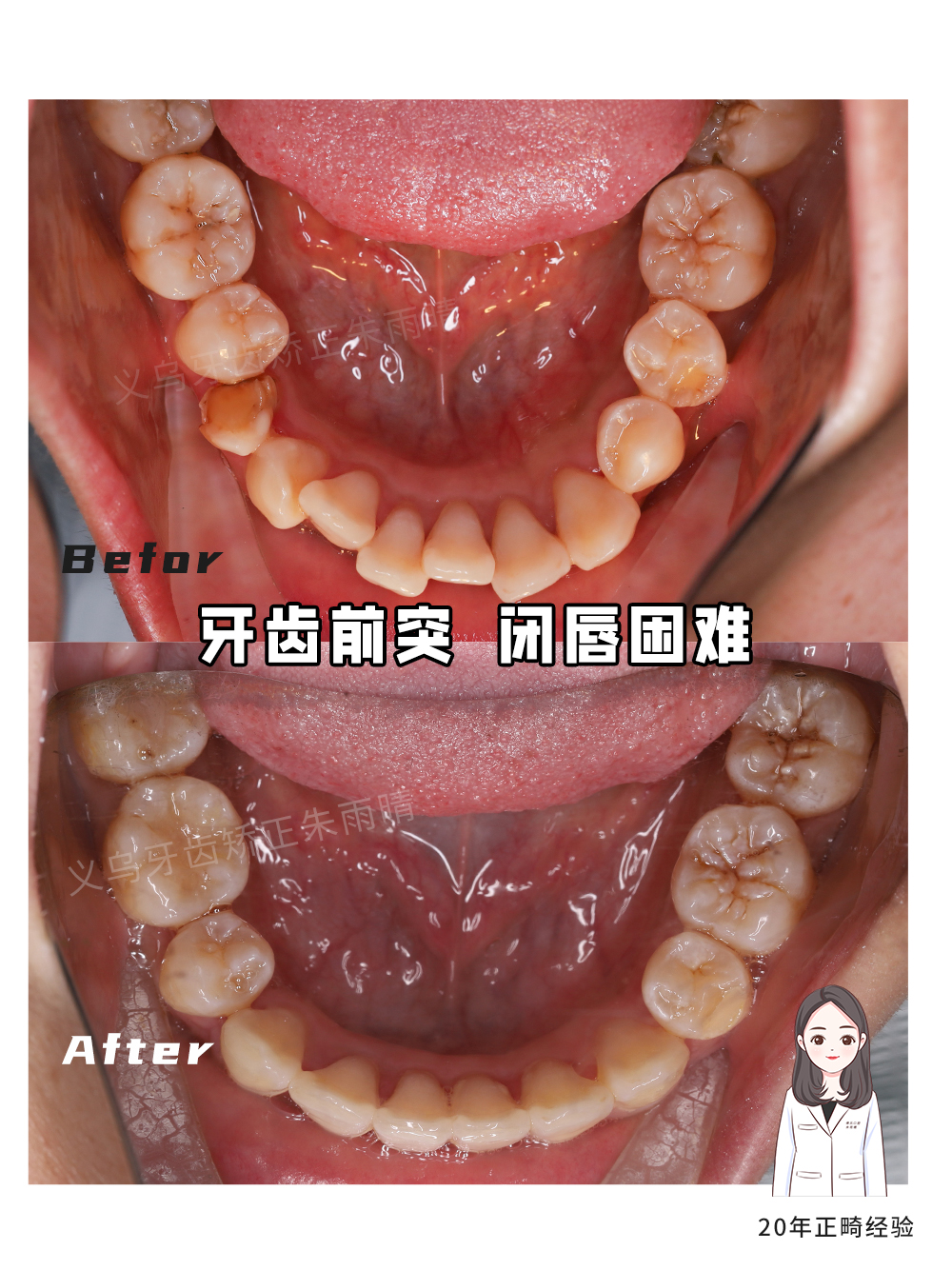 义乌傅氏口腔牙齿前突闭唇困难矫正案例分享！