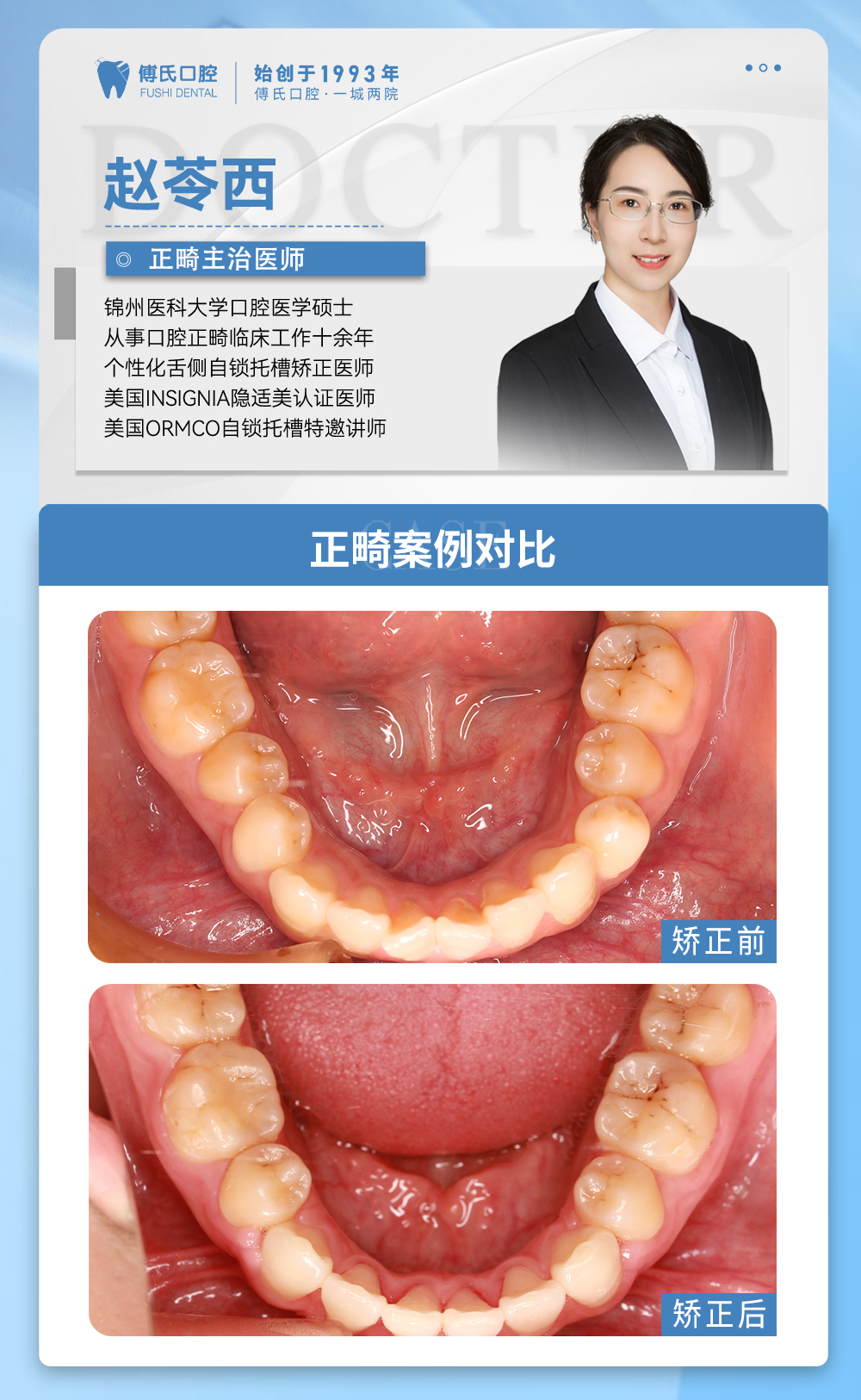 傅氏口腔牙齿拥挤侧貌微凸矫正案例分享! 傅氏口腔牙齿拥挤侧貌微凸矫正案例分享!