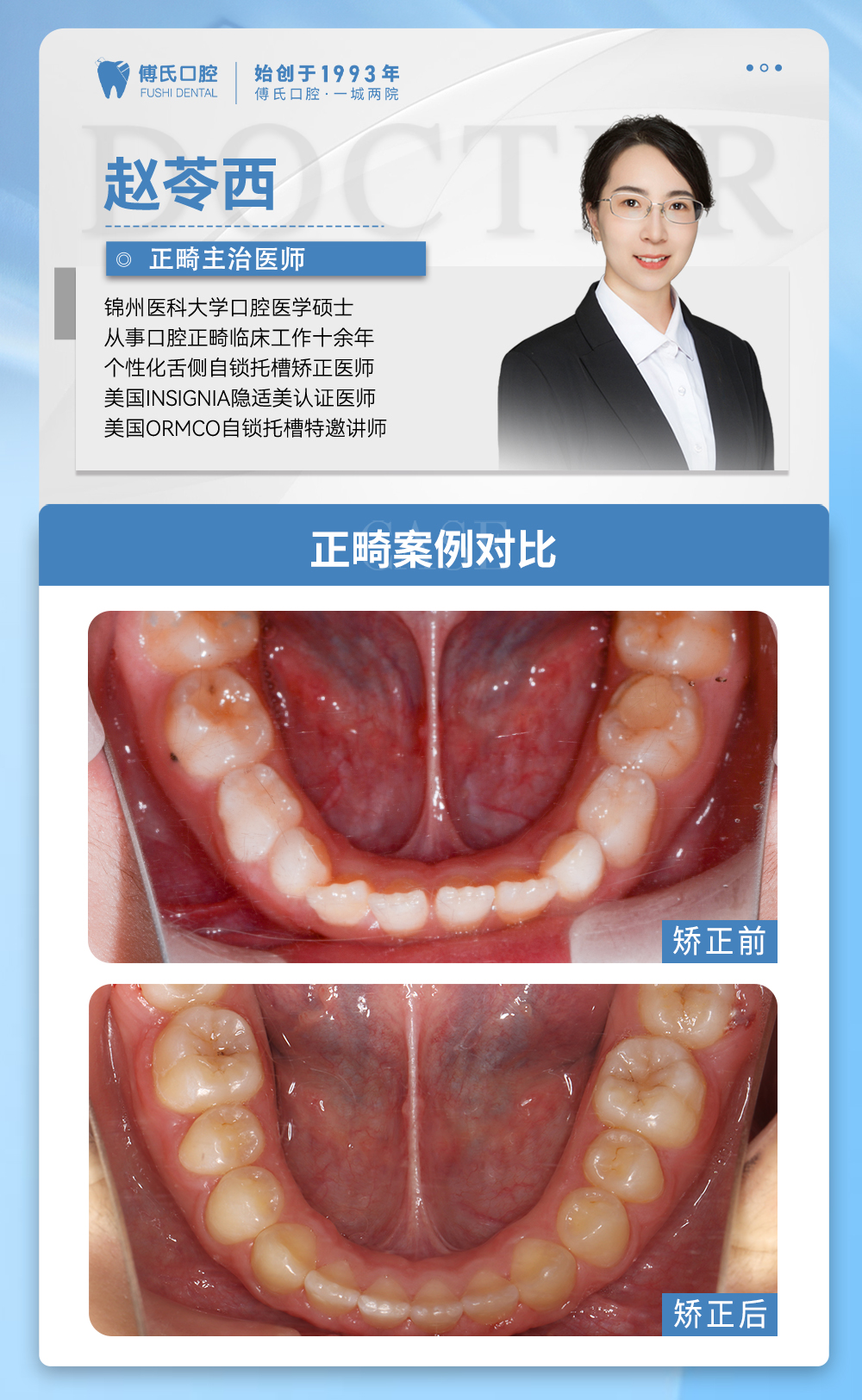 义乌傅氏口腔嘴凸下巴后缩牙齿散隙矫正案例分享！