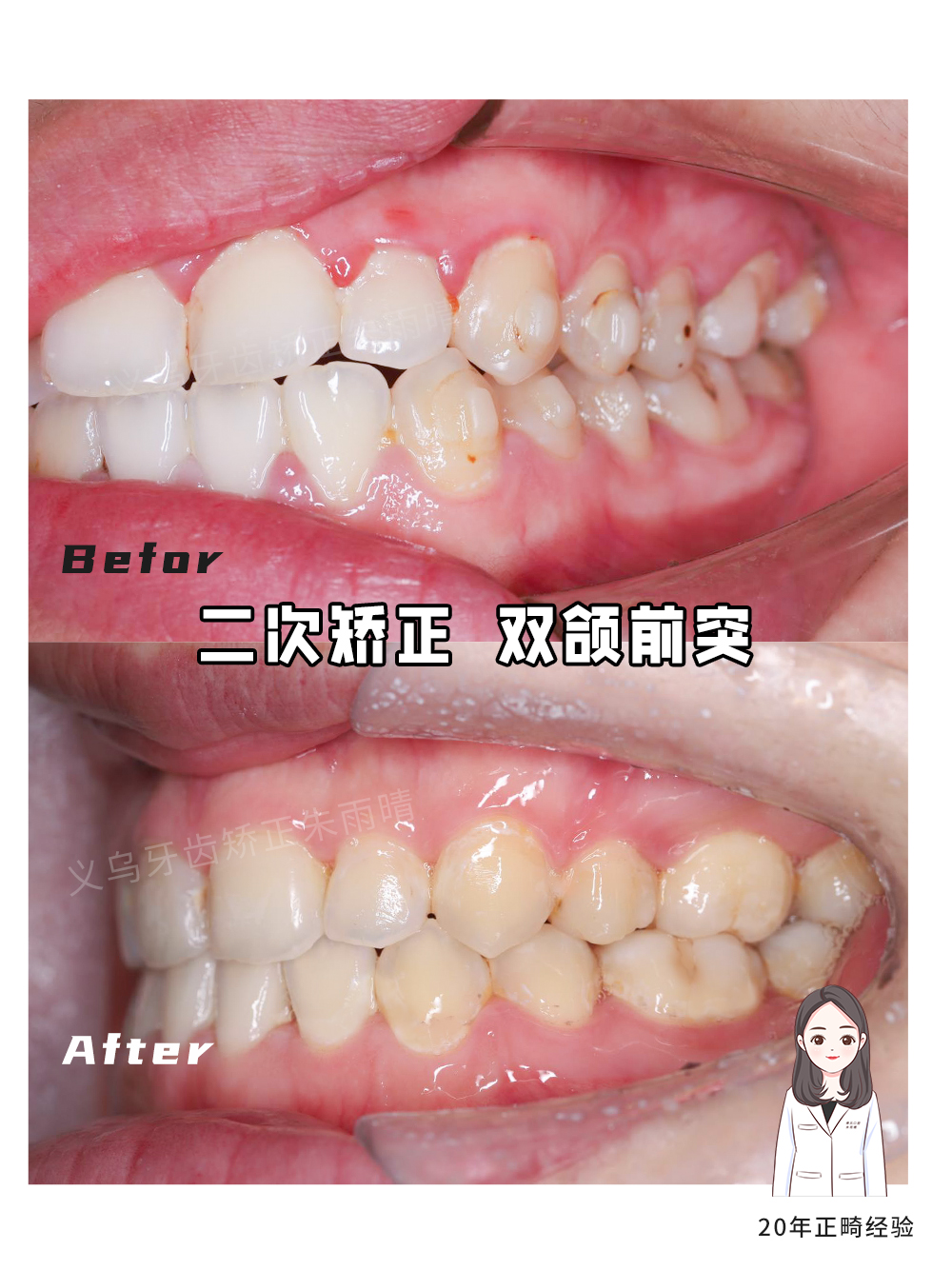 义乌傅氏口腔嘴凸二次矫正案例分享！