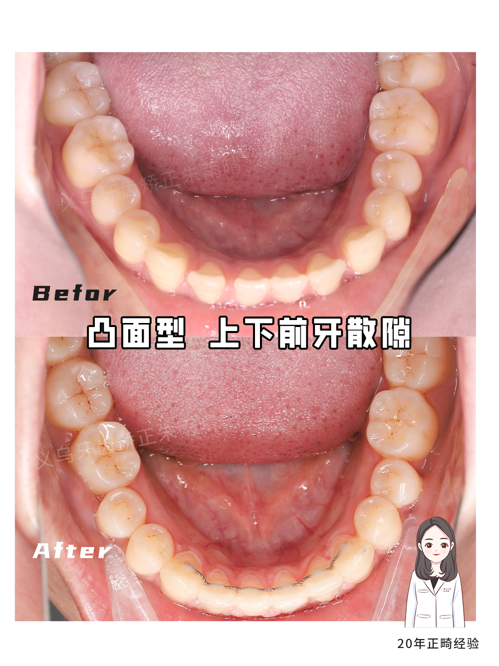 义乌傅氏口腔凸面型上下前牙散隙矫正案例分享！