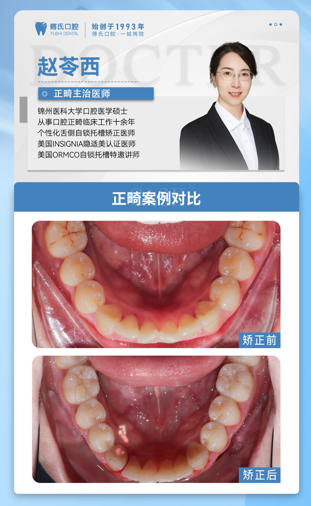 义乌傅氏口腔牙齿前突、嘴凸矫正案例分享! 义乌傅氏口腔牙齿前突、嘴凸矫正案例分享!