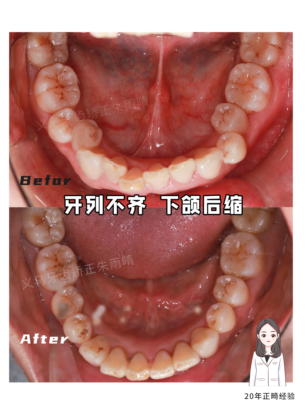 义乌傅氏口腔牙列不齐下颌后缩矫正案例分享！