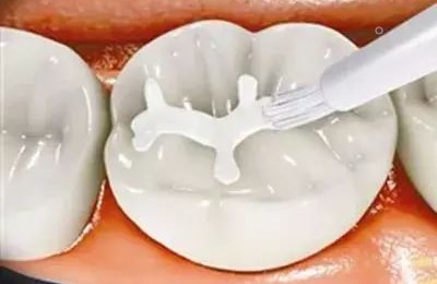 有一种爱叫窝沟封闭! 有一种爱叫窝沟封闭!