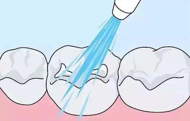 有一种爱叫窝沟封闭! 有一种爱叫窝沟封闭!