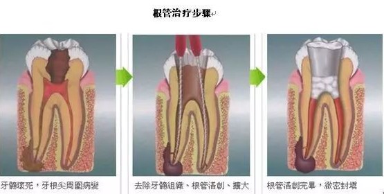 为何最近老是晚上牙疼，白天又不疼？
