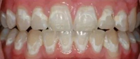 拆了牙套，牙齿上为何会有白斑？