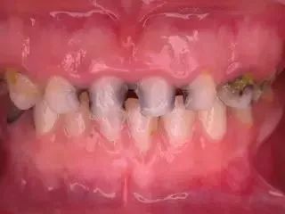 家长不注重儿童口腔健康导致满口烂牙